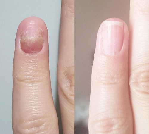 Лечение грибка на руках народными методами в домашних условиях поэтапно